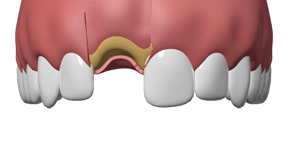 Implant dentaire Pont à Mousson