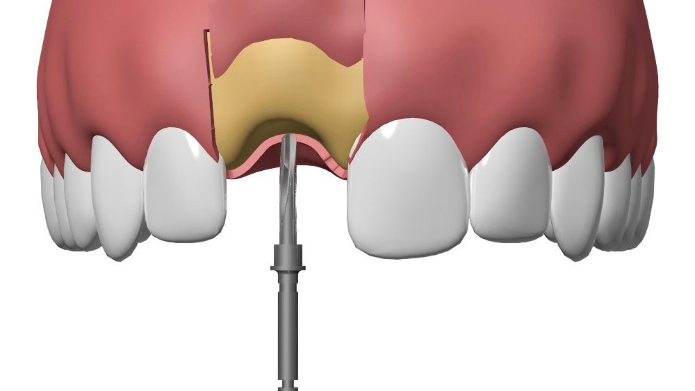 Pose Implants dentaires Pont à Mousson