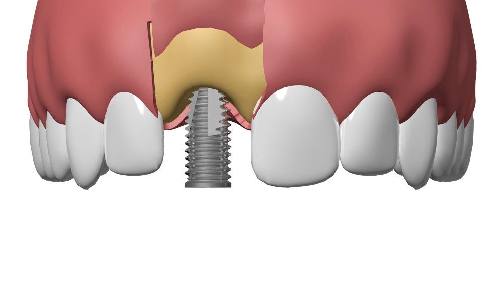 Implants dentaires Pont à Mousson