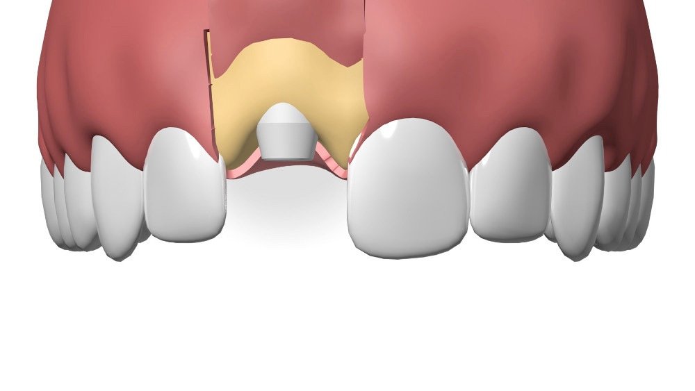 Implants dentaires Pont à Mousson