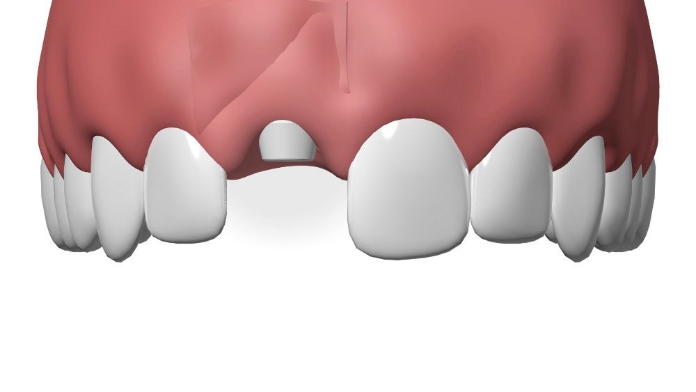 Implants dentaires Pont à Mousson