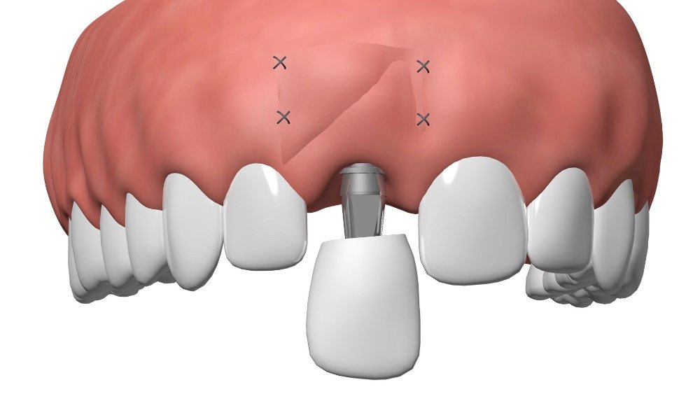 mise en charge immédiate implantologie dentaire Pont à Mousson
