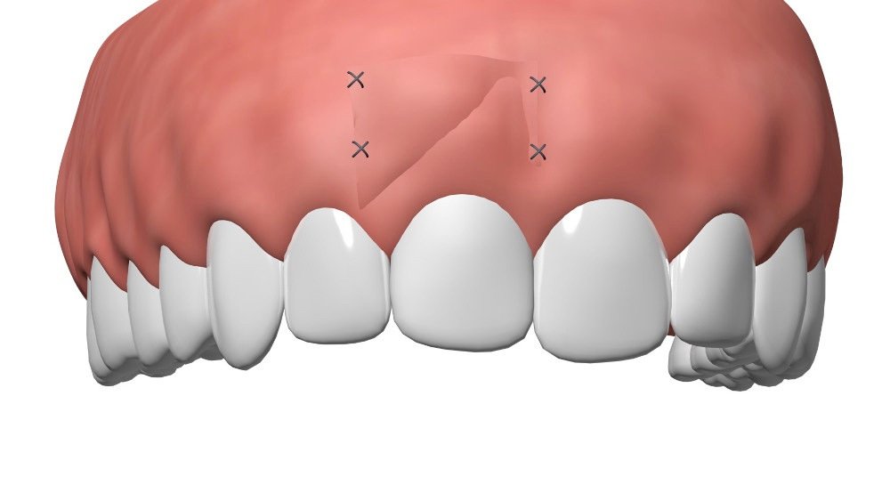 mise en charge immédiate implant dentaire Pont à Mousson
