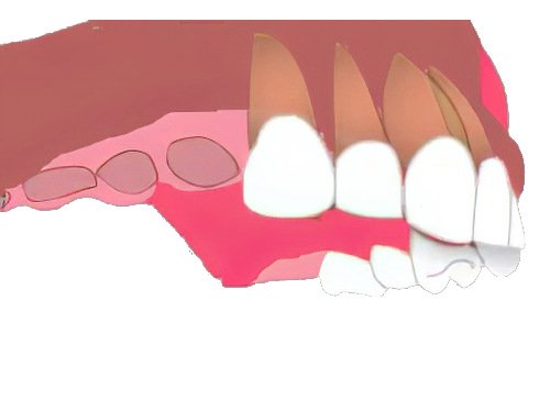 Implants dentaires Pont à Mousson