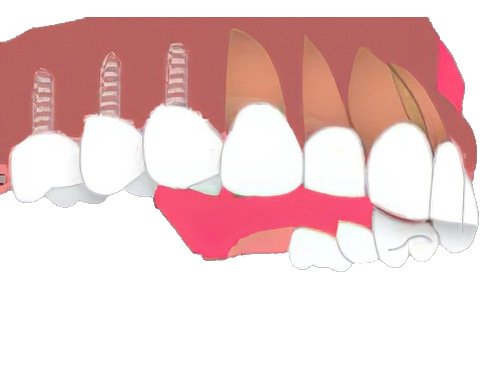 couronnes sur implants dentaires Pont à Mousson