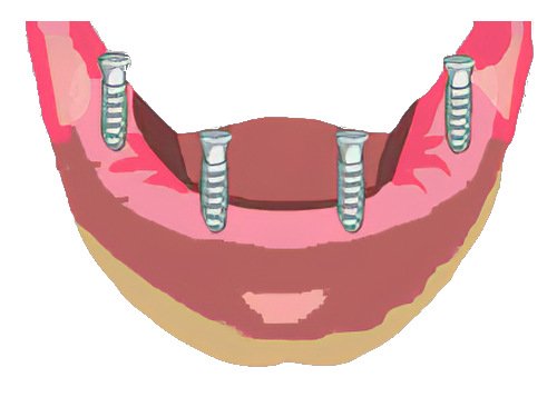 appareil amovible Implants dentaires Pont à Mousson