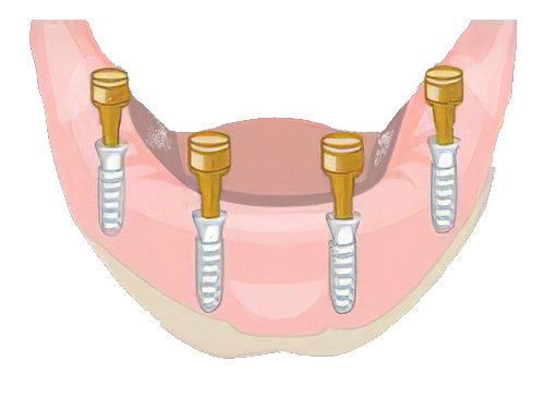 dentier sur Implants dentaires Pont à Mousson