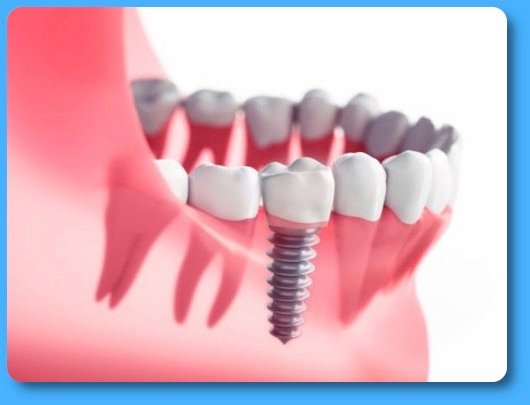 Implants dentaires Pont à Mousson