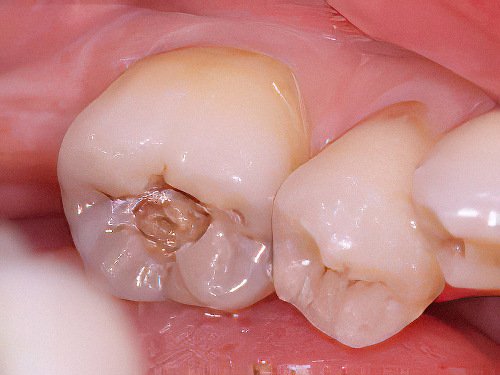 parodontologie Pont a Mousson Carie-dentaire 07