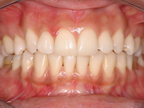 Dechaussement-Dentaire-10 maladie parodontale