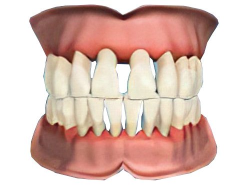 parodontologie Pont a Mousson Dechaussement-Dentaire-11