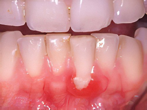 Pont_a_Mousson Gingivite-01