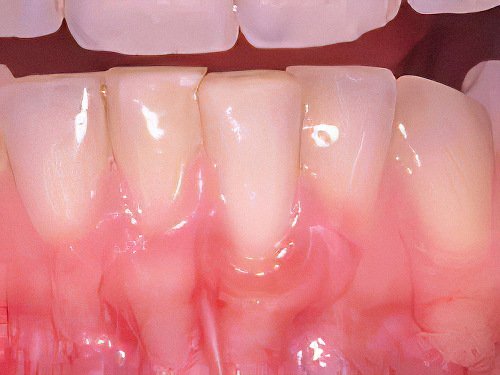 Maladie parodontale Gingivite-02 Pont_a_Mousson