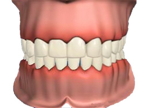 parodontologie Gingivite_Pont a Mousson