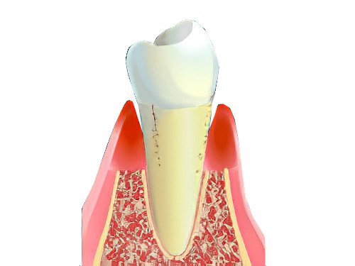 parodontologie Parodontite-01