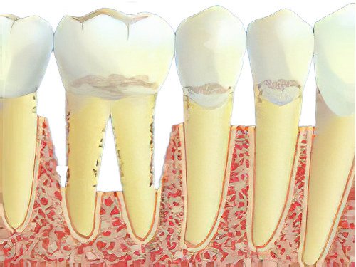 parodontologie maladie parodontale Parodontite-03