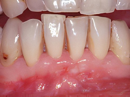 Maladie parodontale Tartre-Dentaire-03-1