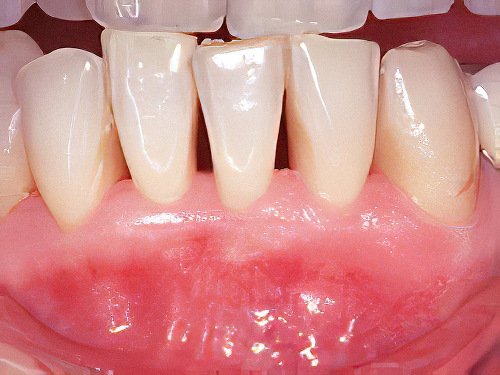 parodontologie Maladie parodontale Tartre-Dentaire-04-2 Pont a Mousson