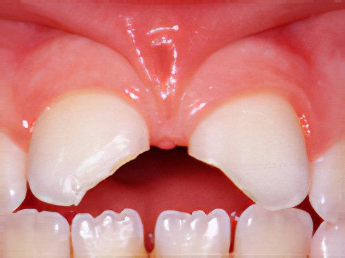 Esthétique dentaire Pont à Mousson composite