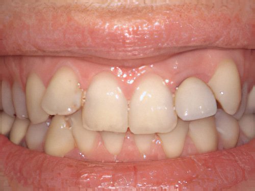 Esthétique dentaire Pont à Mousson couronne dentaire