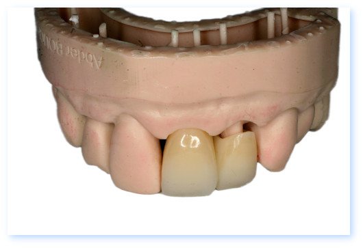 Esthétique dentaire Pont à Mousson couronnes dentaires