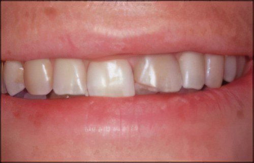 Esthétique dentaire Pont à Mousson dent dévitalisée