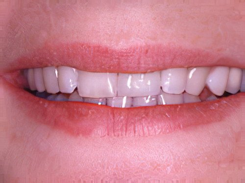 Esthétique dentaire Pont à Mousson dent composite