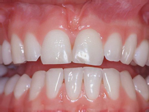 Esthétique du sourire Pont à Mousson dent composite