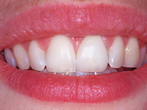 Esthétique dentaire Pont à Mousson dent composite