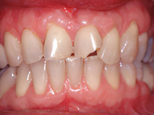 Esthétique dentaire Pont à Mousson facette dentaire