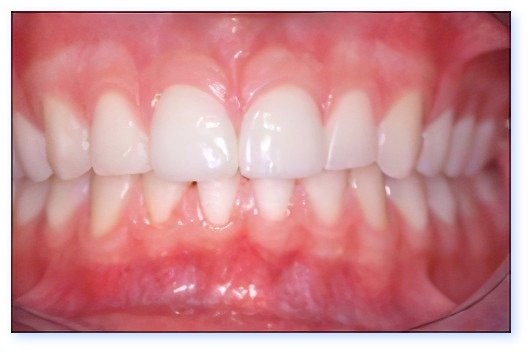 Esthétique du sourire Pont à Mousson