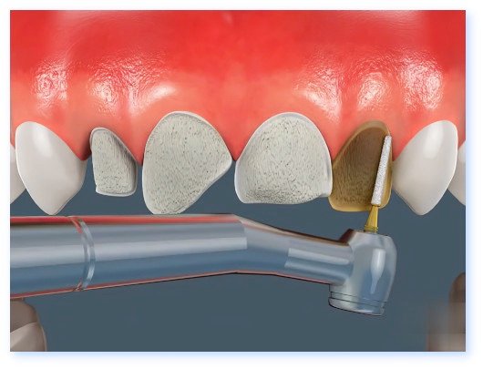 Esthétique dentaire Pont à Mousson facettes dentaires