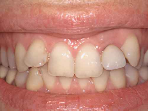 Esthétique dentaire Pont à Mousson sourire harmonieuse