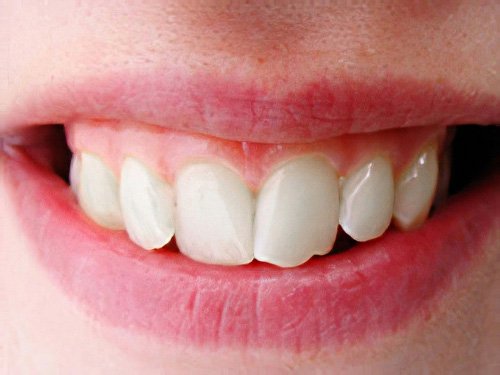 Esthétique du sourire Pont à Mousson orthodontie