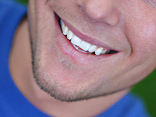 Esthétique dentaire Pont à Mousson